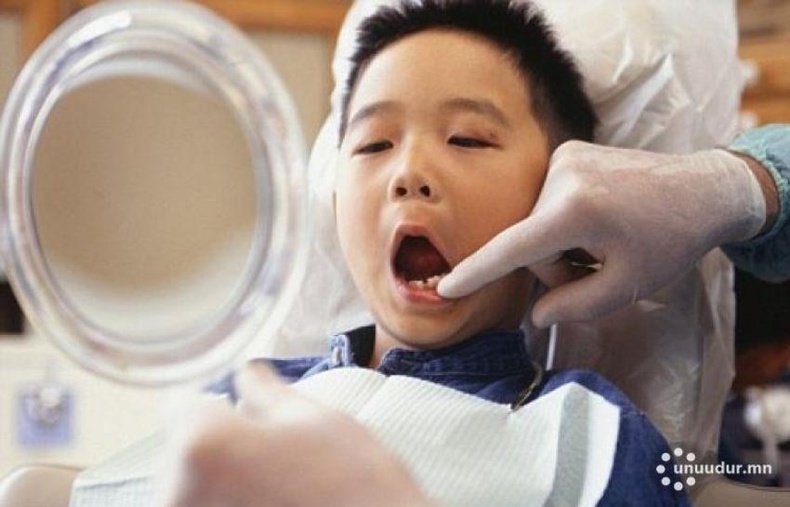 “Эрүүл шүд-Эрүүл хүүхэд” хөтөлбөрийн хүрээнд 2458 хүүхдийн шүдийг эмчилжээ